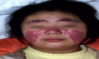 蝶疮流注