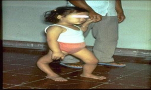 软脚瘟