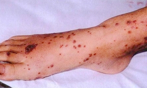 变应性皮肤血管炎