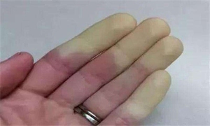 血痹