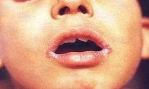 口吻疮