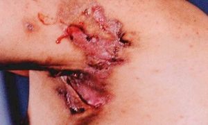 化脓性汗腺炎
