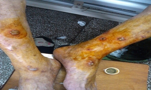 脓窝疮-病因-治疗方法-鉴别,检查,预防,日常生活护理-注意事项-中国