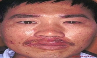 狐惑
