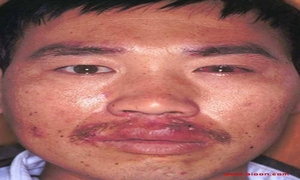 狐惑