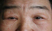 肌痿