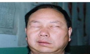 耳面瘫