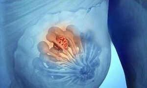 乳岩