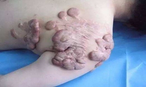 蟹足肿