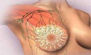 乳疽