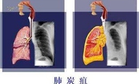 肺炭疽