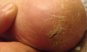 皴裂疮