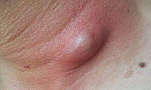软疖
