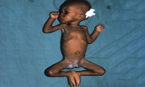 小儿蛋白质-能量营养不良