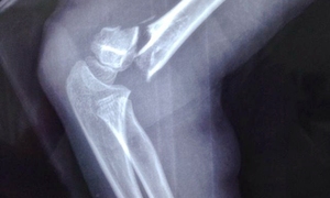 肱骨髁上骨折