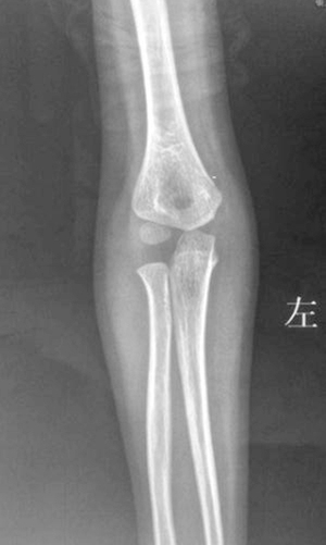 桡骨头半脱位