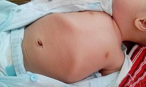 维生素D缺乏性佝偻病