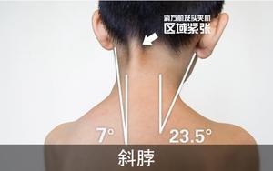 先天性肌性斜颈