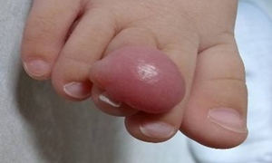 血瘤