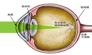 近视