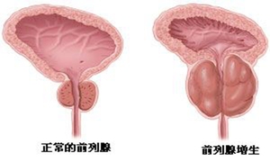 精癃