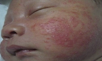 奶癣