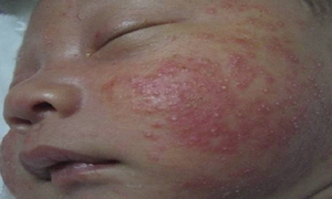 奶癣