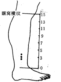瘰疬灸