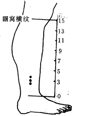 瘰疬灸