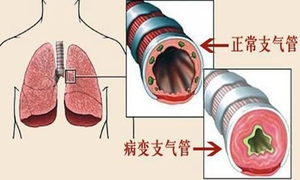 哮病
