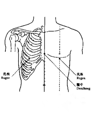 通乳术（胸三针）
