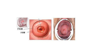 慢性宫颈炎
