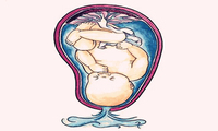 胎膜早破