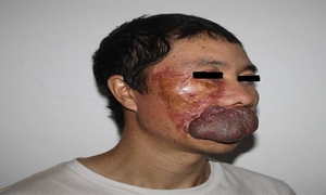 唇菌