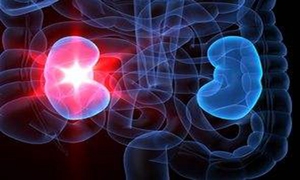 急性肾衰