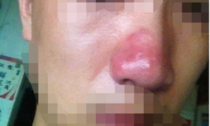 鼻疔