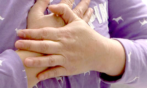 神经节苷脂沉积病