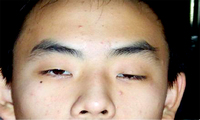 重症肌无力
