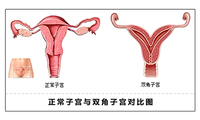 双角子宫