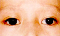 小角膜