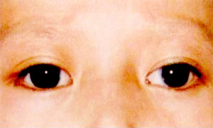 小角膜