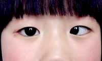 麻痹性斜视