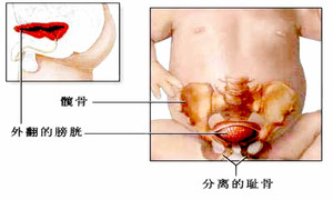 膀胱外翻