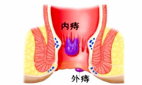 外痔