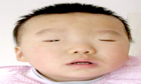 先天性睑裂狭小综合征