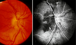 缺血性视神经病变