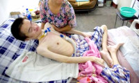 进行性肌营养不良