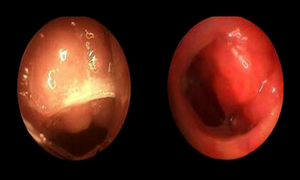 小儿腺样体肥大