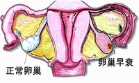 卵巢早衰