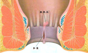 肛裂